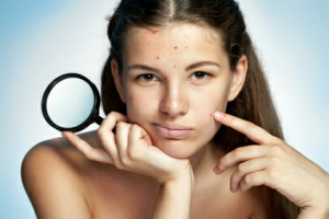 suplemento-melhor-para-acne